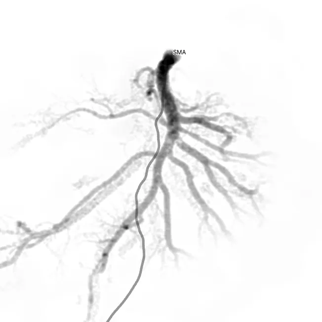 Simulated DSA of the SMA, early arterial frame