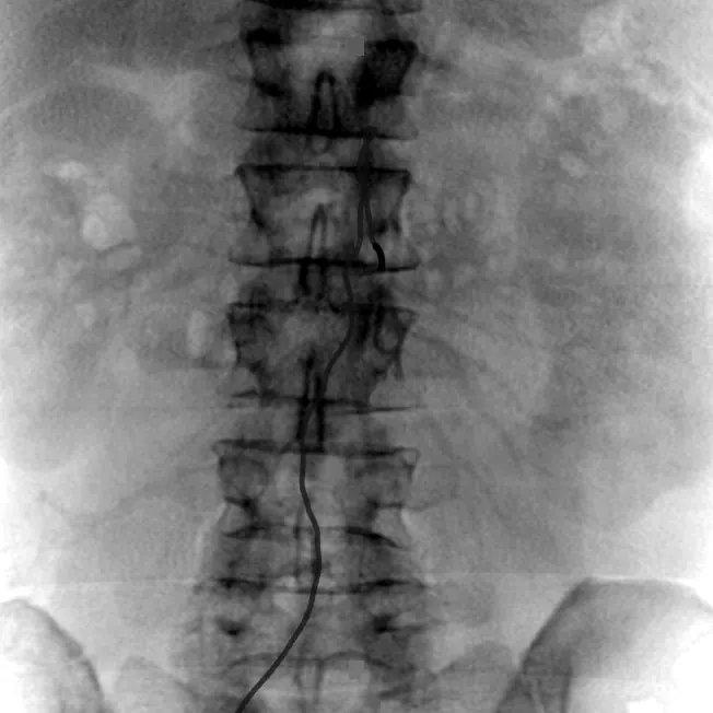 Simulated fluoroscopy with the catheter in the SMA, AP